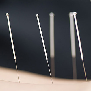 acupuncturists los angeles Miracle Acupuncture