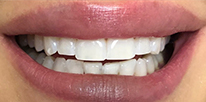 After theeth whitening in Los Angeles CA