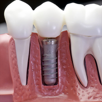 teeth whitening in los angeles Dr. Bill Dorfman, DDS – Century City Aesthetic Dentistry